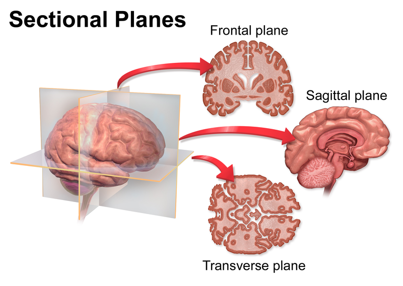 Image of slices of the human brain; three possible 2-D cuts through the brain: a coronal or frontal slice (top image), a sagittal slice (middle), and a horizontal slice (bottom), which is also known as a transverse or axial slice.