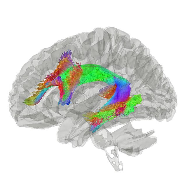 DTI image showing the white matter tracts, including the arcuate fasciculus, a bundle of axons that connects Broca’s area and Wernicke’s area.