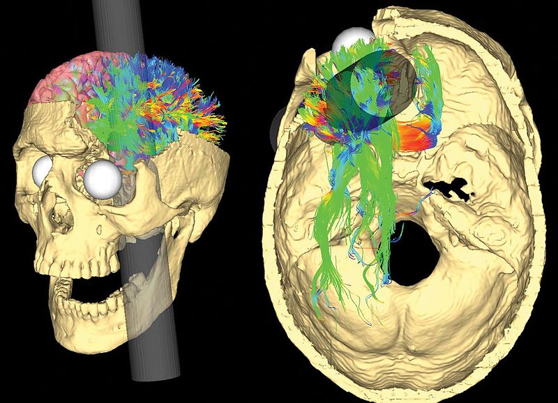 A computerized tomography (CT) image reconstruction of the path of the tamping rod that entered Phineas Gage’s mouth and blasted through his skull and left frontal lobe.