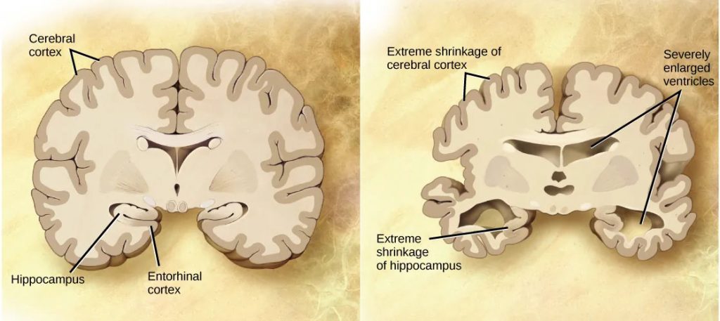 diagram of a normal brain (left), the brain from a patient with Alzheimer’s disease (right) shows a dramatic neurodegeneration, particularly at the shrunken hippocampus and enlarged ventricles.