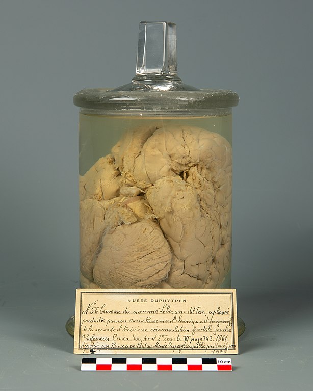 Photo of the brain of Broca’s patient, Louis Victor Leborge (“Tan”) preserved in jar in a museum in Paris.