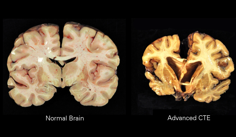 Cross section of a normal brain and advanced CTE brain.