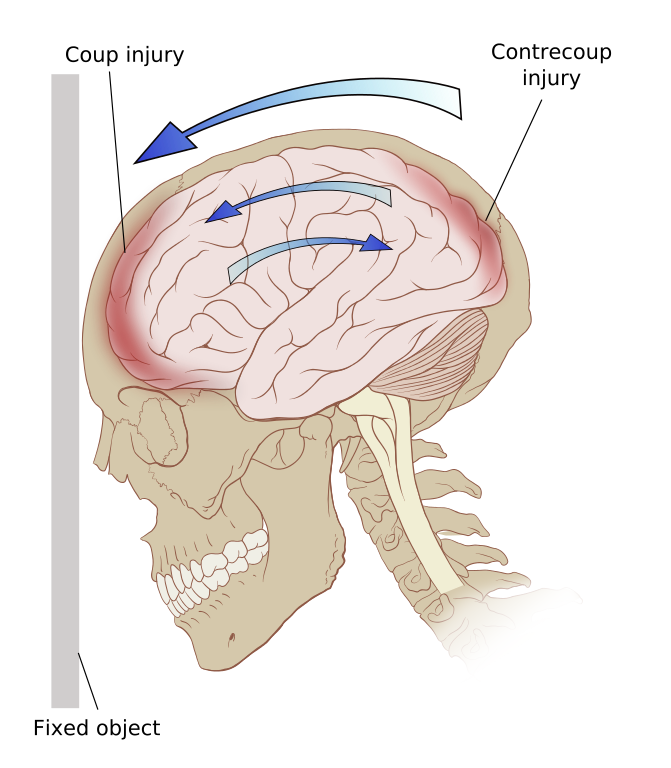 diagram of the forces on the brain in a coup-contrecoup injury.