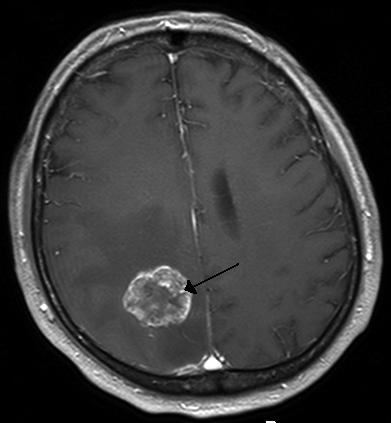 black and white image of a metastatic tumor in the cerebral hemisphere from lung cancer, shown on magnetic resonance imaging