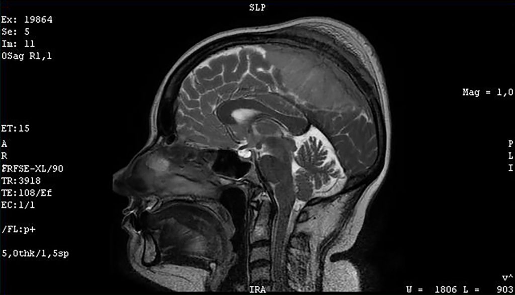 Black and white cross section of the human head demonstrating the meningioma of the sagittal sinus isolated.