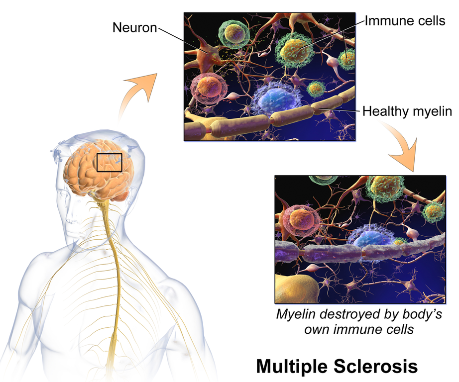 diagram of the brain of patient with Multiple Sclerosis