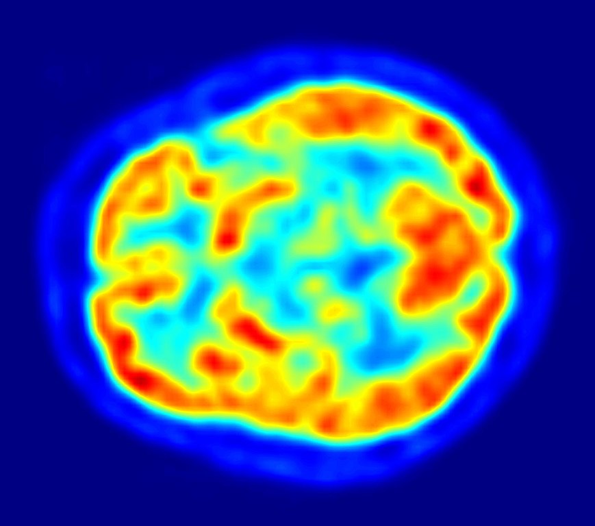 Image of a transaxial slice of the brain taken with positron emission tomography (PET).