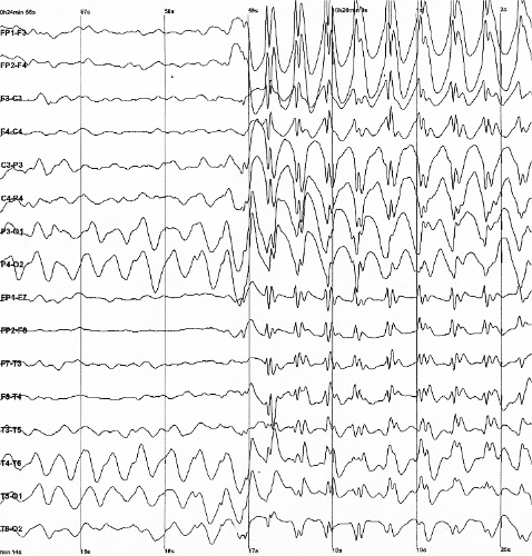 Example of the EEG spike waves.