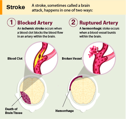 Illustration of a stroke caused by a blocked artery or ruptured artery.