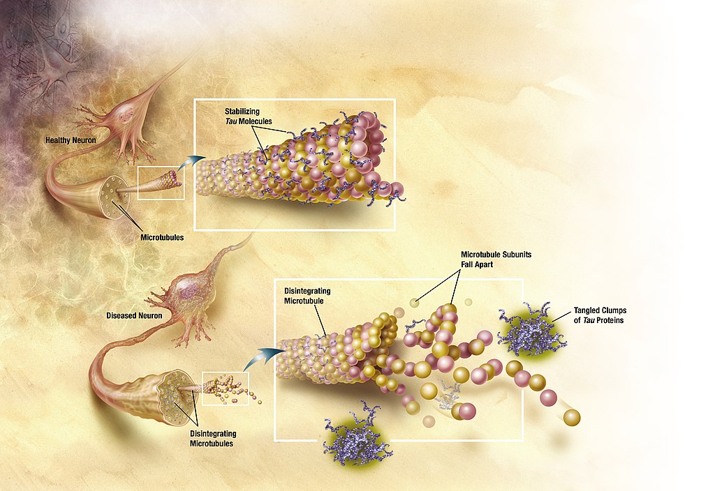 Diagram of how microtubules disintegrate with Alzheimer's disease.