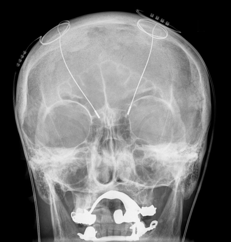 X-ray of the skull with deep brain stimulation probes.