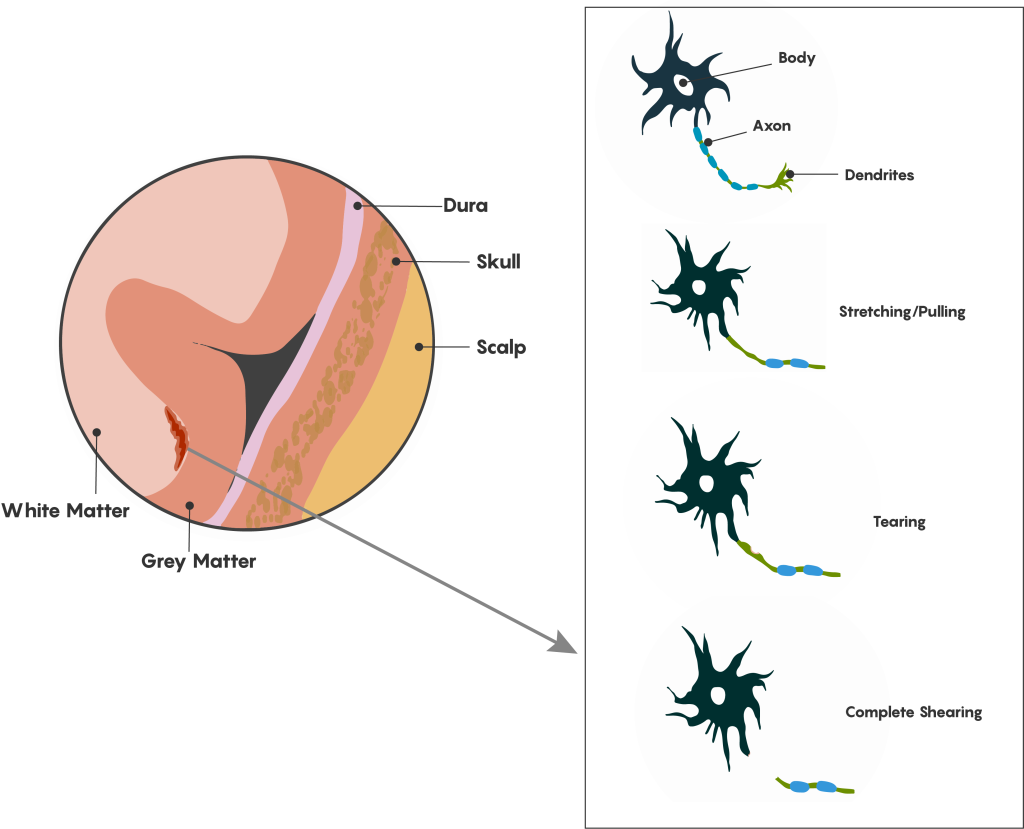diagram of diffuse axonal injury