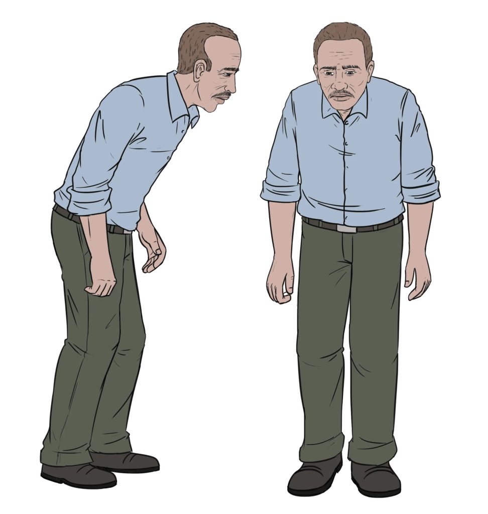 drawing of Parkinson’s patients with hunched posture and walk with slow, shuffling steps.