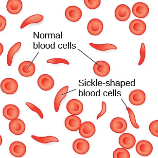 Illustration of normal vs sickle blood cells