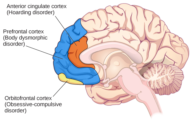 Illustration of the brain with regions associated with obsessive-compulsive disorder in color.