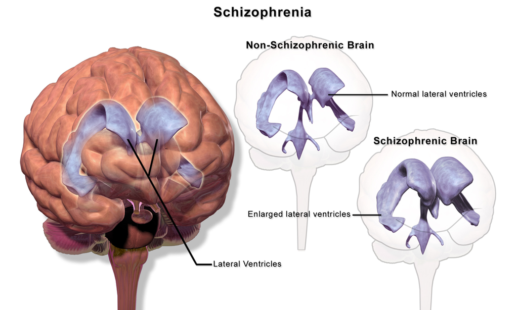 3D render of a non-Schizophrenic versus a Schizophrenic brain.