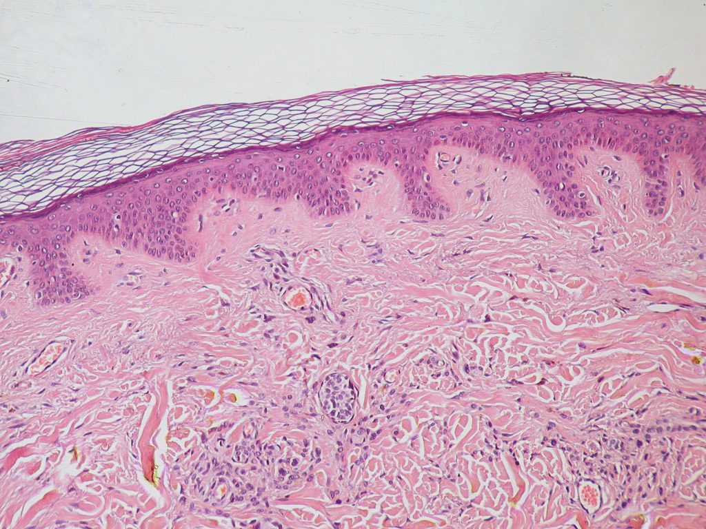 This image shows the epidermal and dermal layers of the skin, with an intradermal nevus visible in the dermis. The nevus appears as a collection of pigmented cells (melanocytes), which are typical of benign moles. The image highlights the structure of healthy skin along with the presence of the nevus.