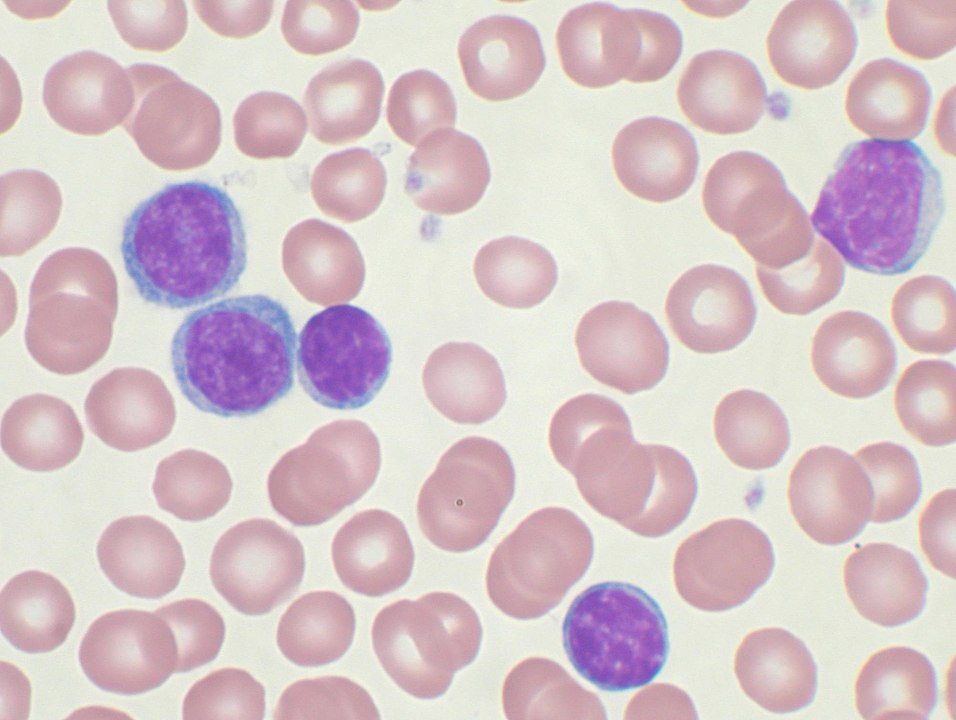 Lymphocytic leukemia cells