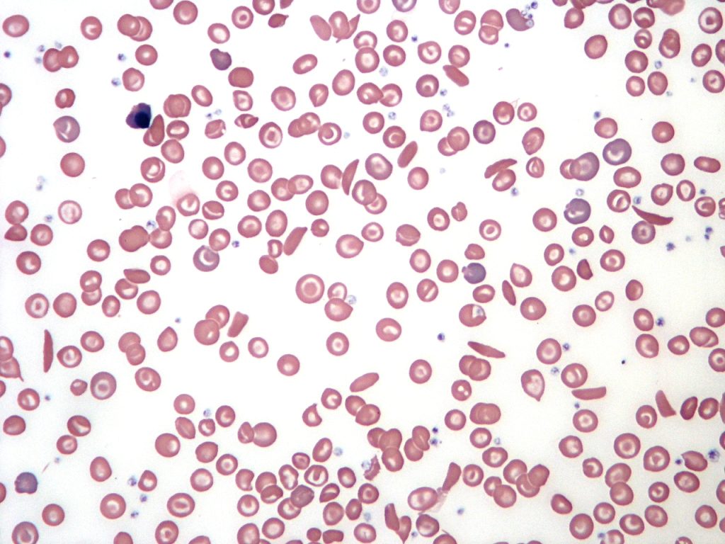 Peripheral blood smear