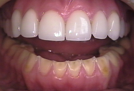 image of teeth damaged by bulimia