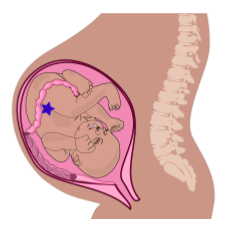 Cartoon diagram of a fetus in the uterus.