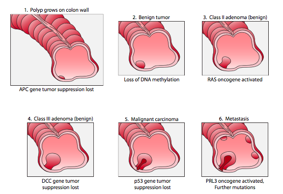 Cancer requires multiple mutations in both tumor suppressor and protooncogenes. Each stage gives mutant cells a growth advantage. Colon cancer begins with a benign polyp, accumulating mutations until it becomes cancerous and can invade surrounding tissue.