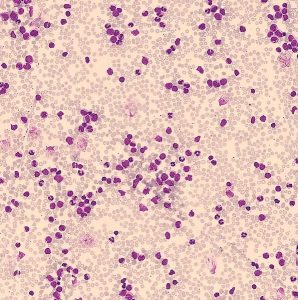 leukemia blood smear (right image)