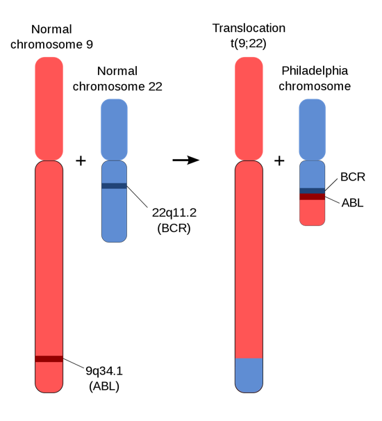 The Philadelphia chromosome results from the fusion of part of chromosome 9 with chromosome 22. At the fusion point, the BCR and ABL genes are brought together to form the BCR-ABL oncogene.