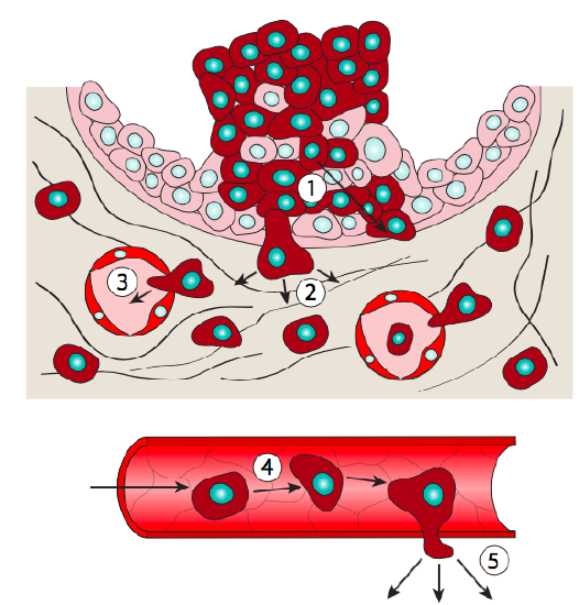 Diagram of the process of metastasis, with cells from a tumor invading the surrounding tissue, entering a blood vessel, and migrating through the body