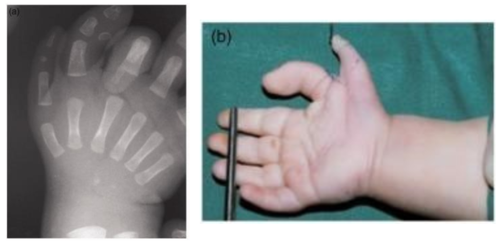 An Xray of a baby's hand, with an extra thumb and extra bones visible in the thumbs and a photograph of a baby's hand with an extra thumb.