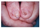 Photo of finger nails in a person with Nail Patella Syndrome.