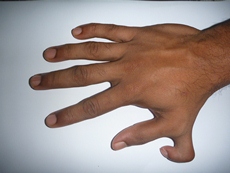 A close-up of a hand with an extra thumb.