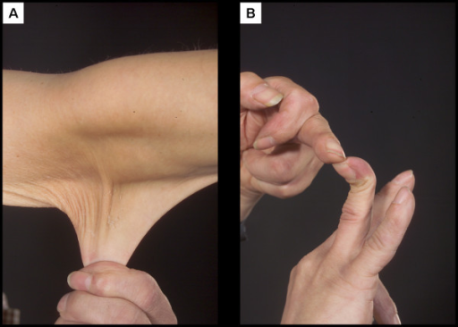 (A) Prominent hyperextensible skin (B) hypermobile joints.