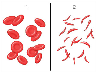 Cartoon of red blood cells. Healthy blood cells (left) and sickled red blood cells (right).