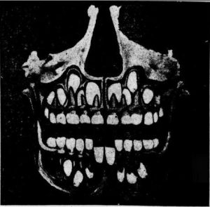 Radiografía de cráneo humano con dientes juveniles y permanentes (1910)